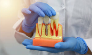 Dental implants cost full mouth restoration will be costly. So, you need preparation for expenses.
